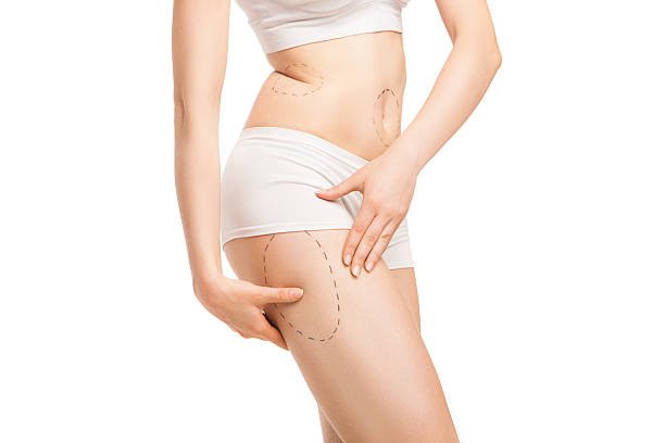 When Is the Right Time to Consider Liposuction?